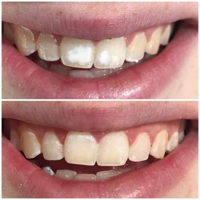 Icon White Spot Removal Annandale NJ Clinton Center Dental